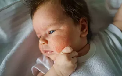 Common Rashes in Children: Identification and Management