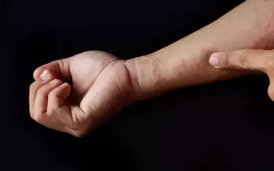 Apogee Therapeutics: Advancements in Atopic Dermatitis Treatment